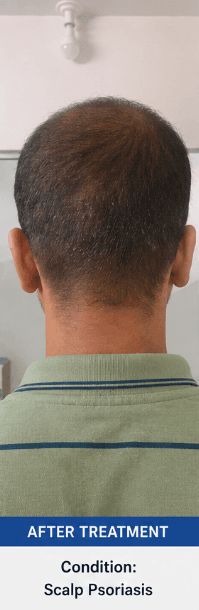 After treatment