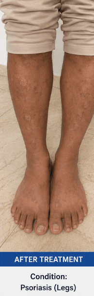 After treatment