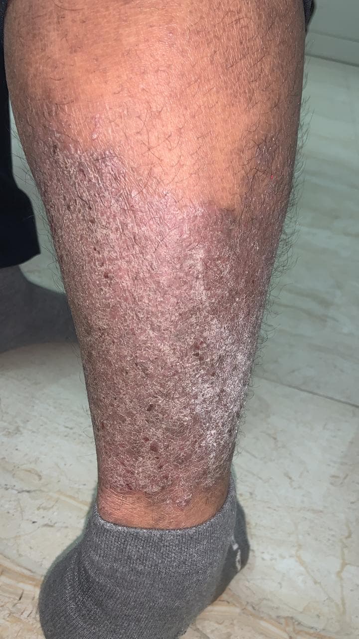 Before treatment