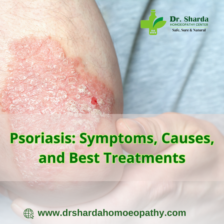 Exploring Psoriasis: Symptoms, Causes, and Best Treatments at the Best Homeopathy Clinic in Aundh